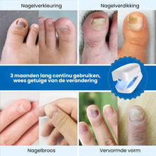 Afbeelding in Gallery-weergave laden, DermaNail - Gepatenteerde nagelschimmeltherapie – voor gezonde nagels binnen 4 weken

