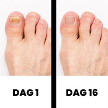 Afbeelding in Gallery-weergave laden, PureNail - Gepatenteerde nagelschimmeltherapie – voor gezonde nagels binnen 4 weken
